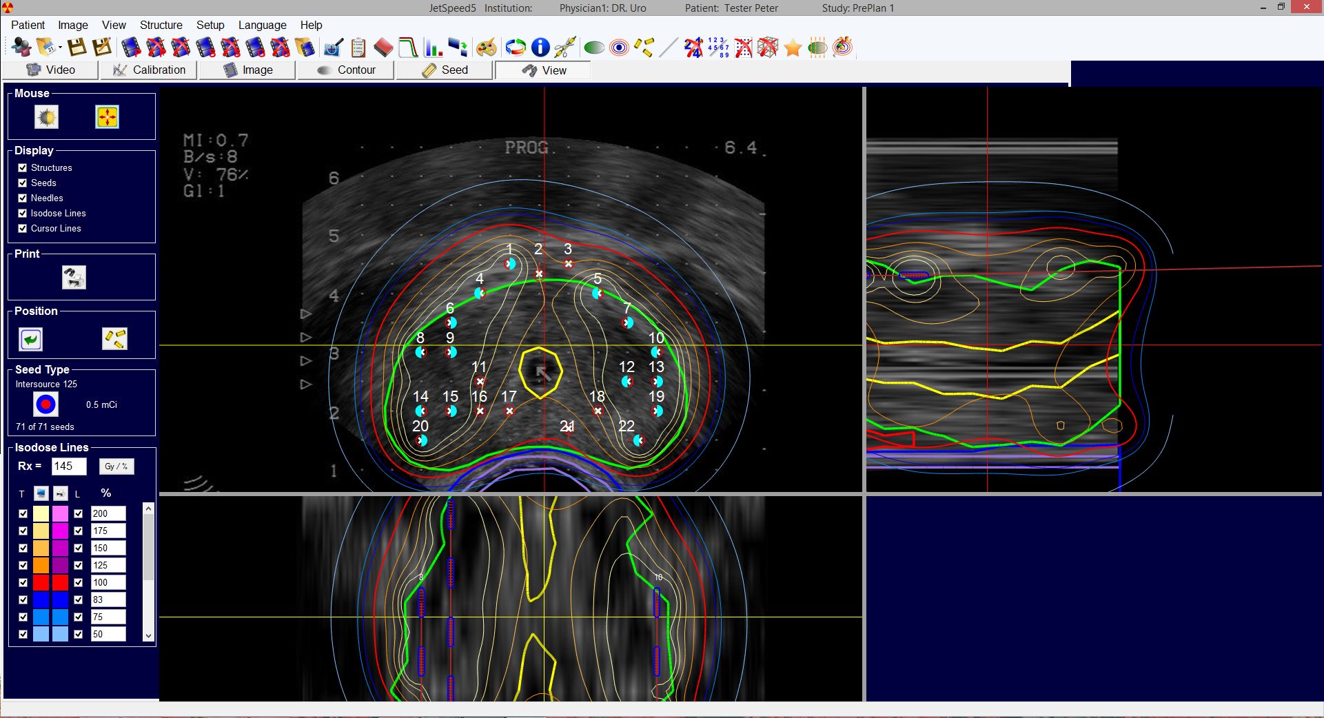 LDR Brachytherapy software JetSpeed5 CT/MR/ultrasound post-planning processes