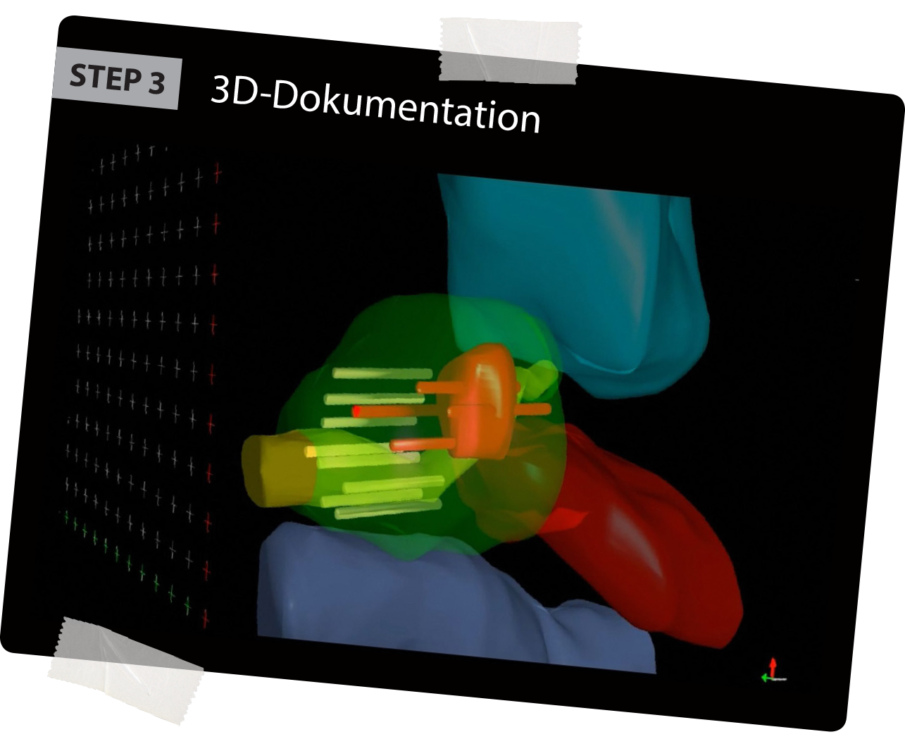 BioJet MRI-Fusionbiopsies Third step Precise biopsies including 3D reconstruction in real time